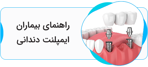 بیماران ایمپلنت
